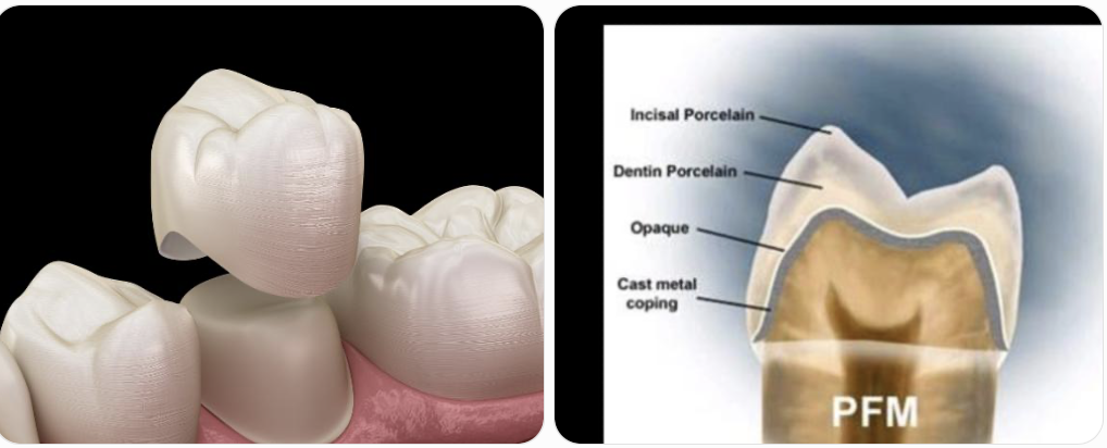 Crown structure diagram showing a PFM crown cross-section with incisal porcelain, dentin porcelain, opaque layer and cast metal coping