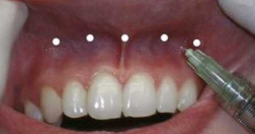 Buccal infiltration injection site