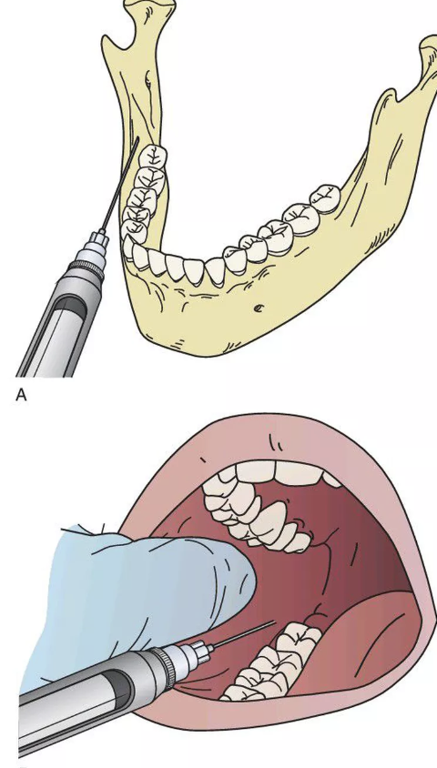 IAN block needle angle illustration