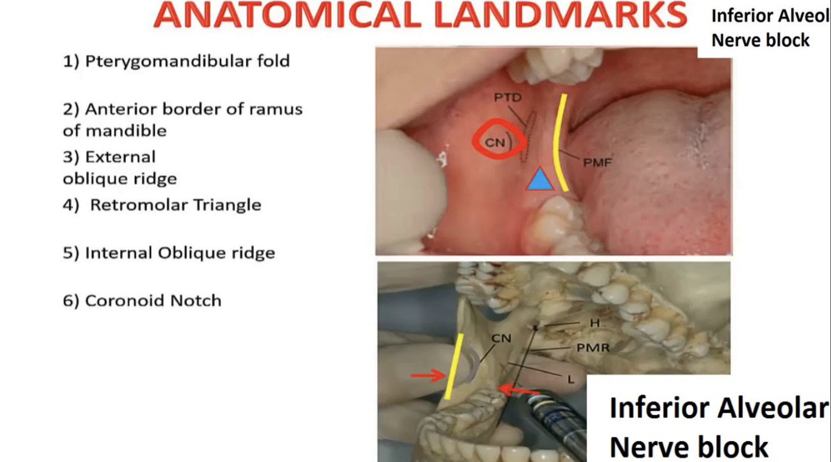 IAN block anatomical landmarks