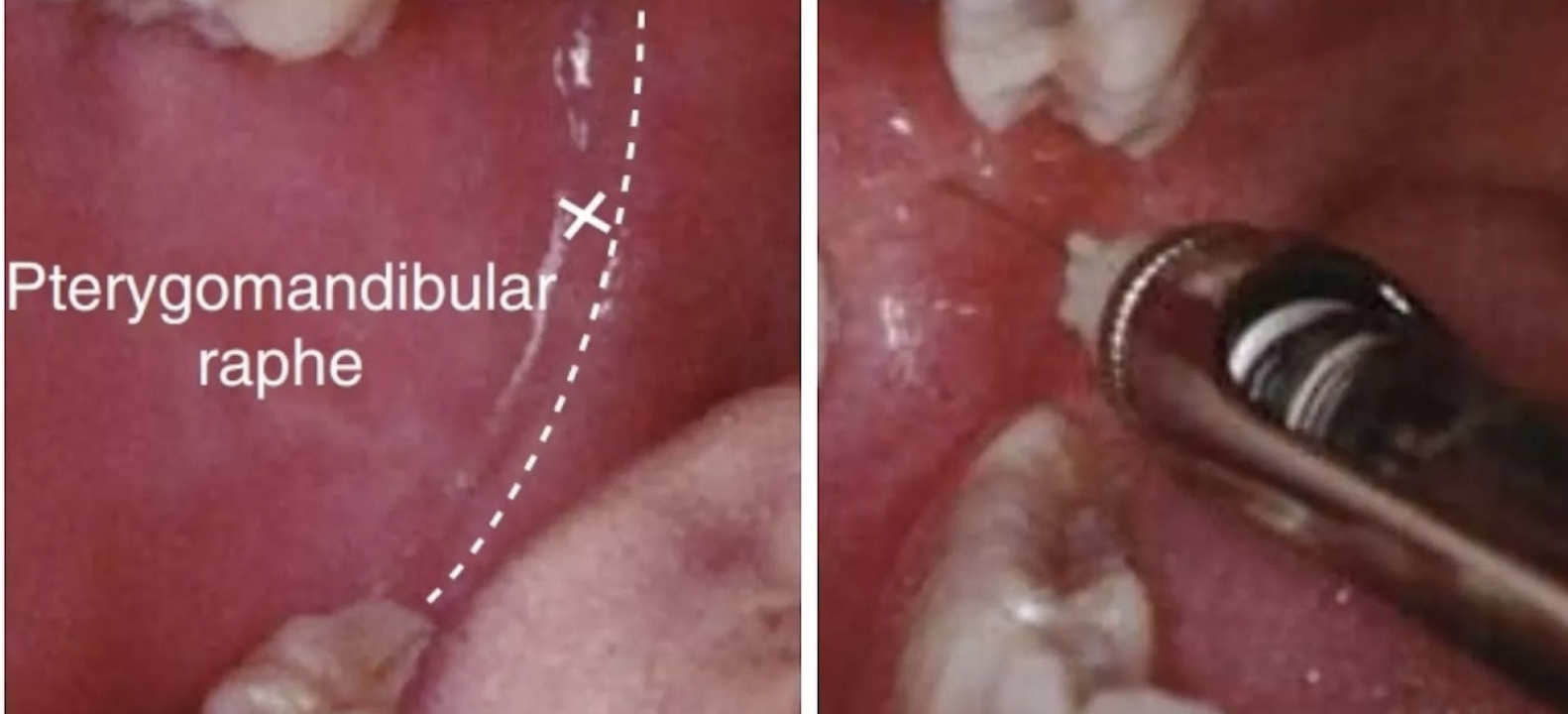 Pterygomandibular raphe close-up