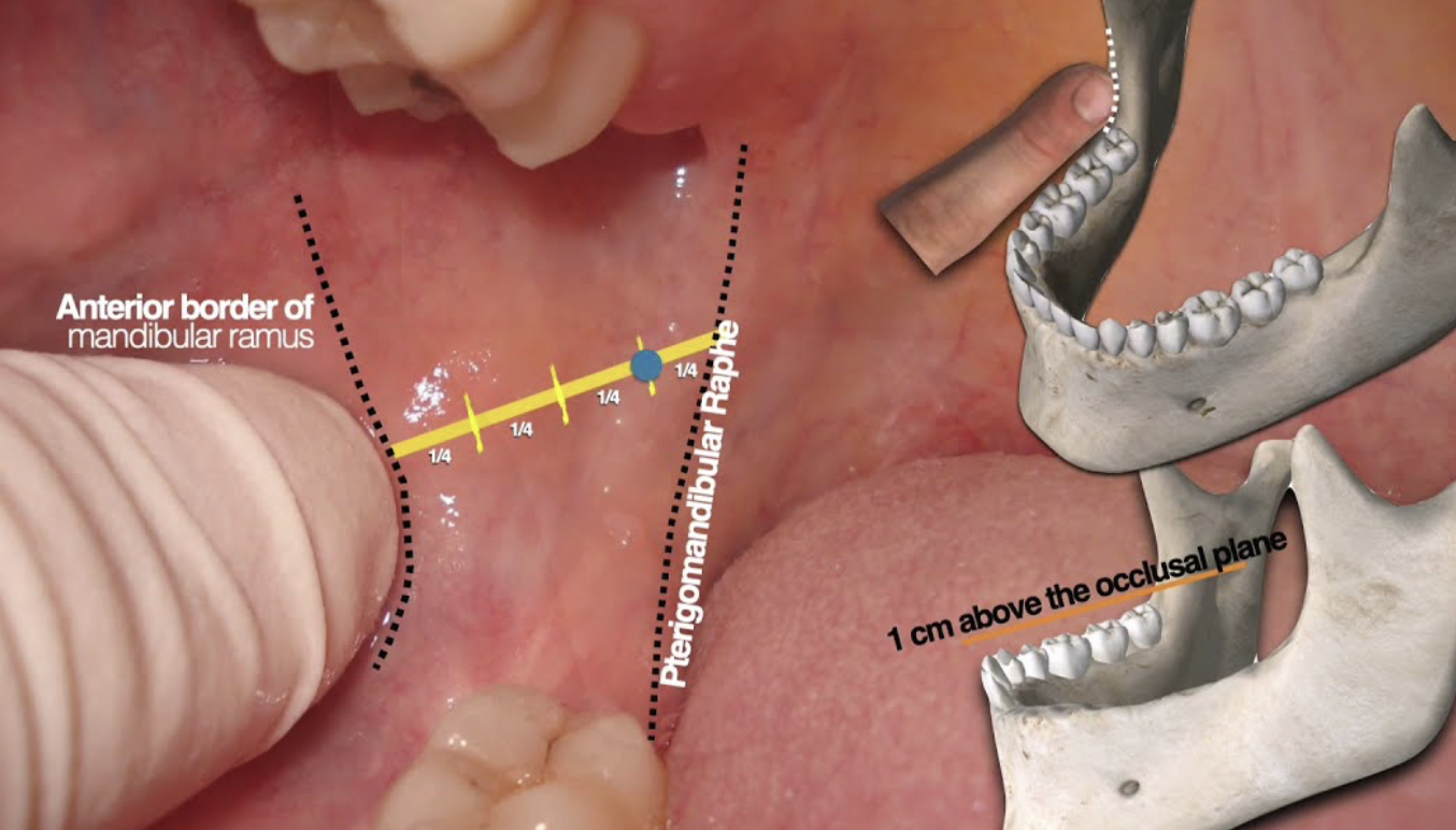 Anterior border of mandibular ramus with 1cm above occlusal plane marker