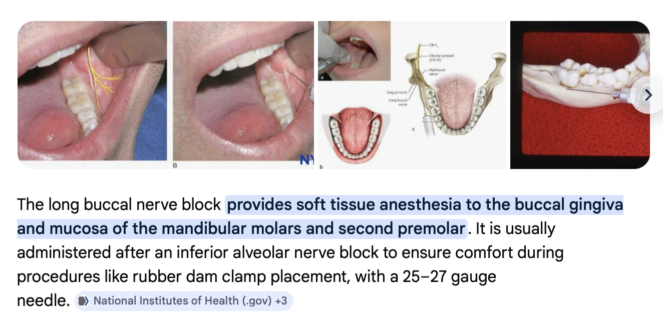 Long buccal nerve block reference