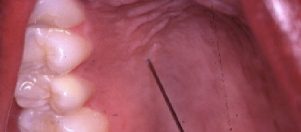 Palatal infiltration injection site