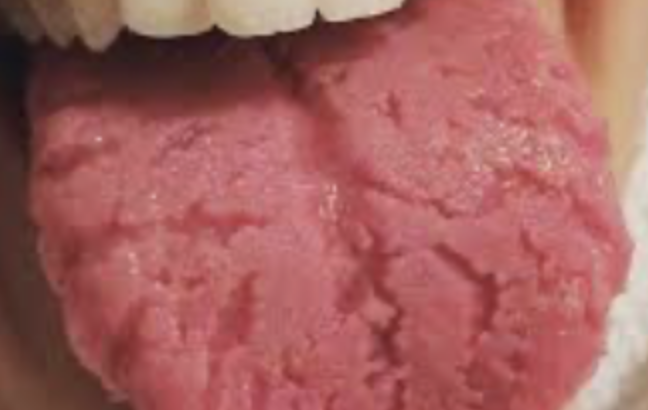 Fissured tongue