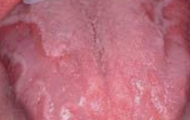 Geographic tongue