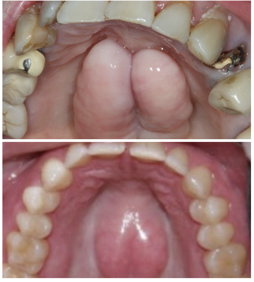 Palatal tori and palatal exostoses