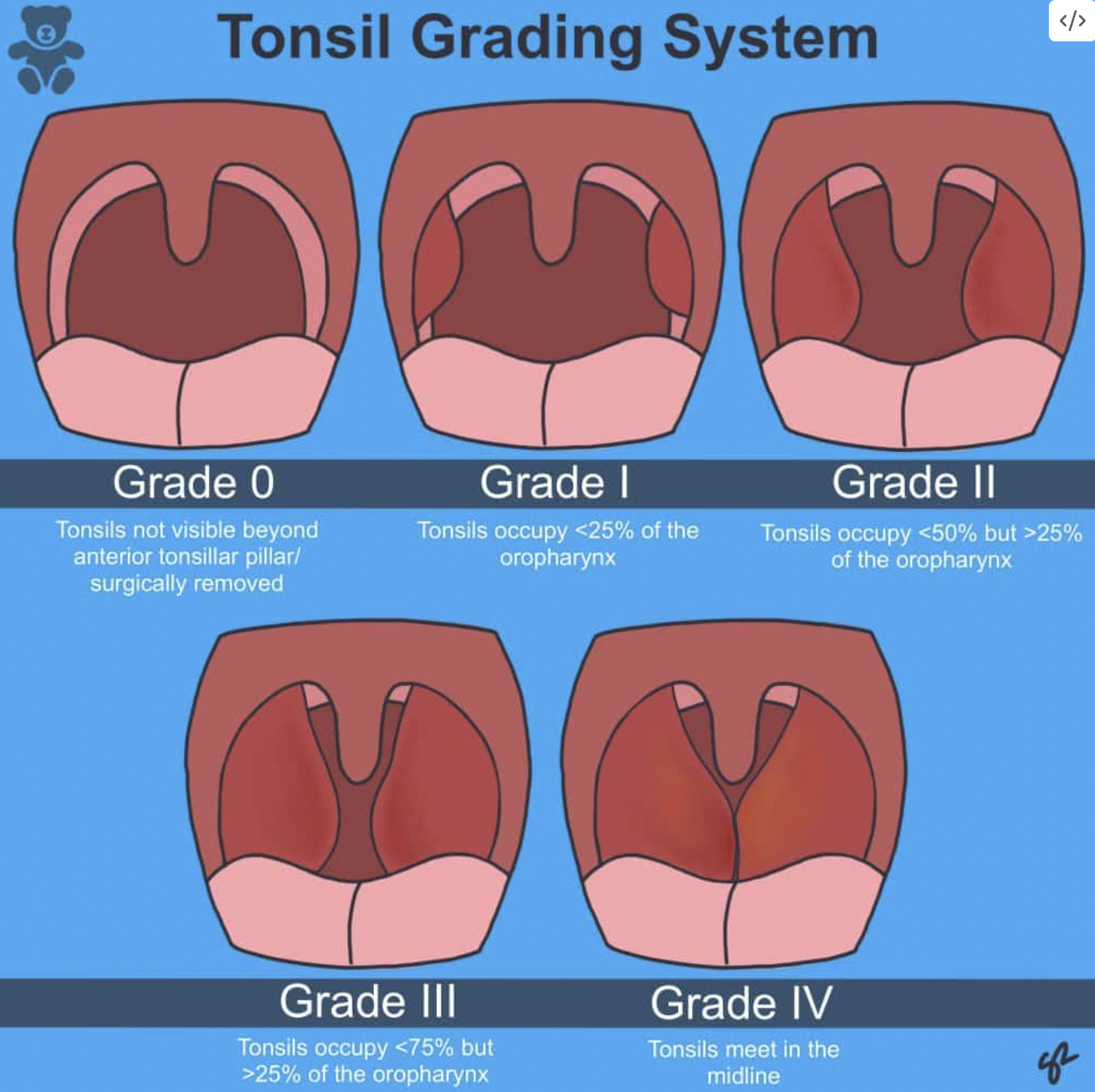 Tonsil grading system 0 to IV